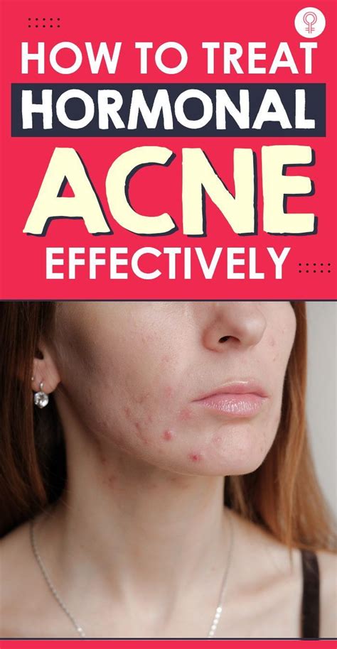 Hormonal Acne Causes How To Treat It And Foods To Avoid Artofit