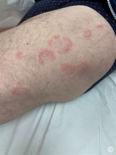 Eosinophilic annular erythema
