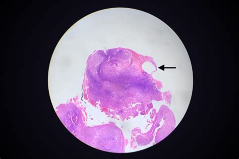 30 Facts About Vaginitis Emphysematosa