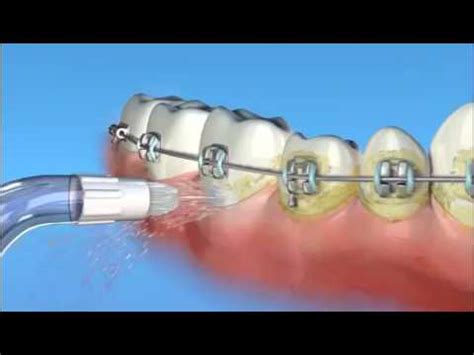 Ортодонтическая насадка для ирригатора Waterpik OD 100E - YouTube