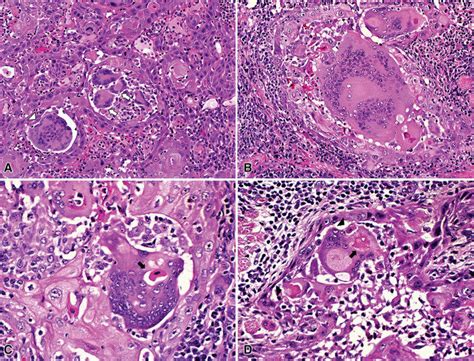 Histopathological Aspects Of Intense Multinucleated Giant Cell Reaction