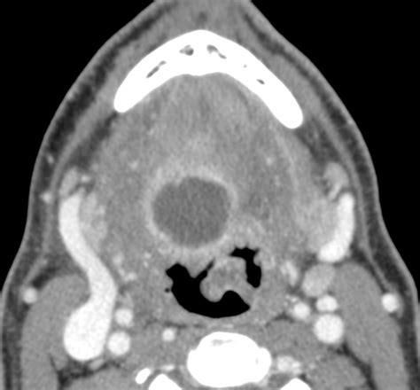 Imaging Of Ectopic Thyroid Tissue And Thyroglossal Duct Cysts