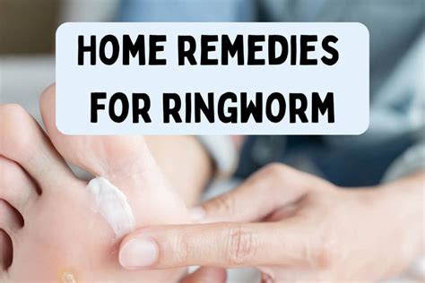 Home Remedies For Ringworm How To Treat It At Home Naturally