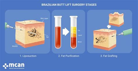 How Long Does a Brazilian Butt Lift Last? - Is It Permanent?