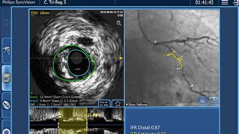 IntraSight Interventional Applications Platform | Philips Healthcare