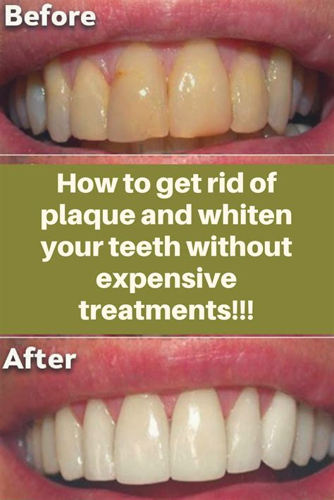 How To Get Rid Of Plaque On Teeth