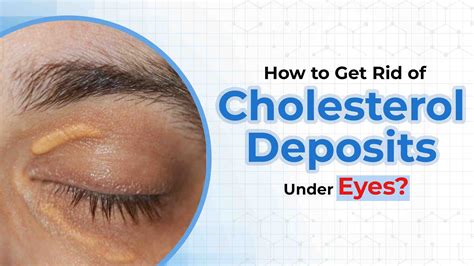 How To Get Rid Of Cholesterol Deposits Under Eyes
