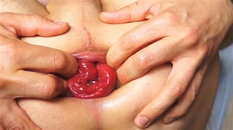 Giant Asshole Prolapse And Rosebutt Big Gape Part Gay Man Man Porn Xhamster