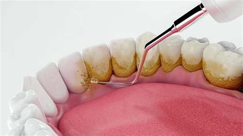 What Causes Tartar on Teeth? – NutritionFact.in