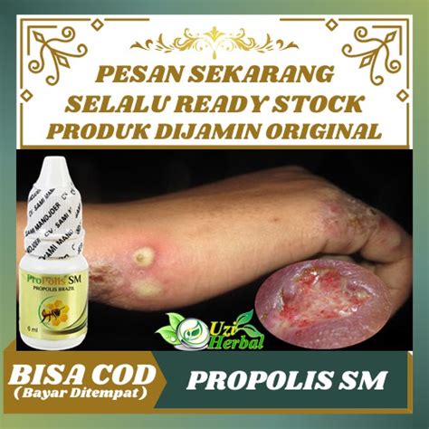 Jual Salep Borok Bernanah Obat Luka Borok Borok Kaki Borok Di Kepala