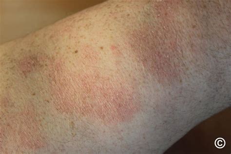 Chronic Superficial Scaly Dermatitis Syn Parapsoriasis Digitate