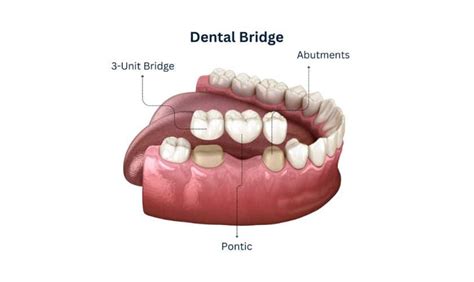 Alternatives to Dental Implants For Front Teeth