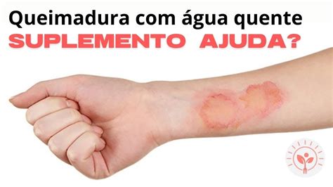 O Que E Bom Para Queimadura Com Agua Quente - DICA PARA RECUPERAÇÃO DA PELE APÓS QUEIMADURA COM ÁGUA FERVENDO (CAFÉ ...