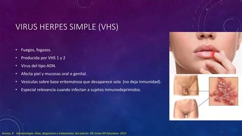 Varicela Virus Herpes Zóster Y Varicela Zóster Ppt