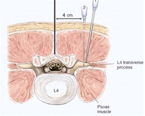 Lumbar Plexus Block