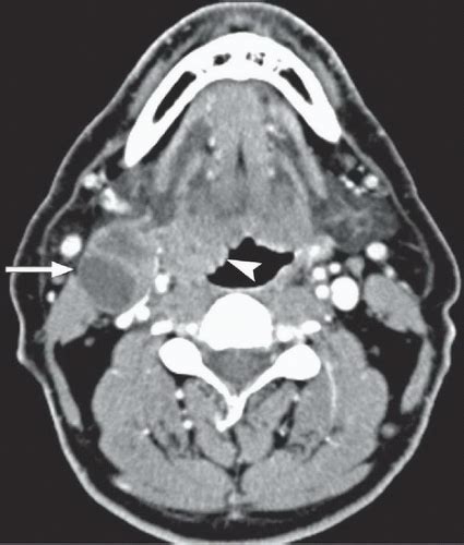 Head And Neck Squamous Cell Cancer With Nodal Metastases Radiology Key