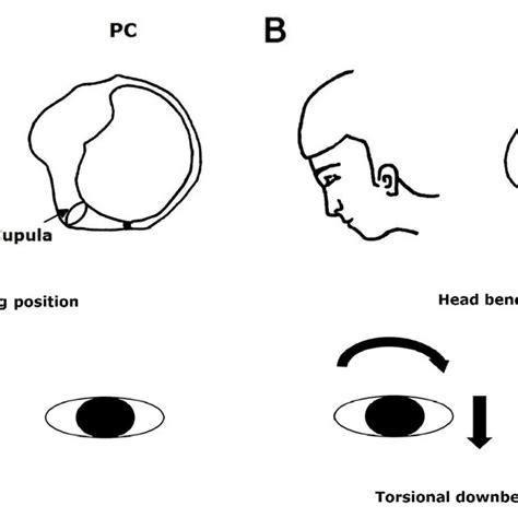 Use Of The Head Bending Maneuver To Induce Nystagmus In Benign