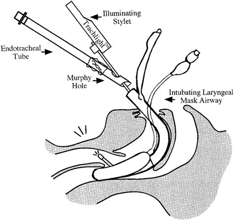 Difference Between Lma And Endotracheal Intubation At Joan Hollowell Blog