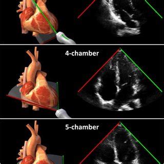 Left Doppler Field In The Left Ventricle Red Blue Color Map With The