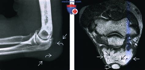 Рентгенограмма, МРТ, УЗИ при бурсите локтевого сустава