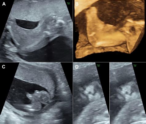 Figure 1 From Prenatal Sonographic And Molecular Genetic Diagnosis Of Popliteal Pterygium