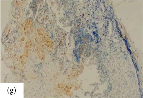 Pdl Staining In Primary Tumor And Metastatic Lymph Node In Gastric