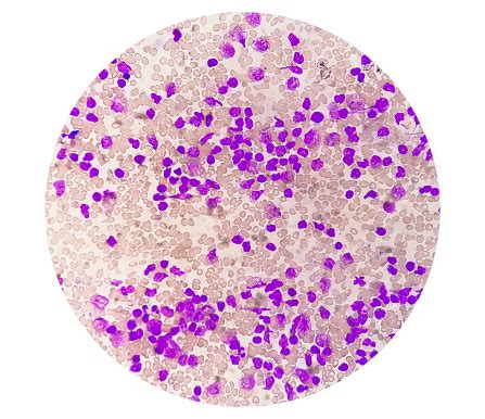 Blood Smear Under Microscopy Showing Chronic Lymphoblastic Leukemia ...