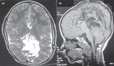 A Axial T2 Weighted Magnetic Resonance Image Showing Partial Fusion