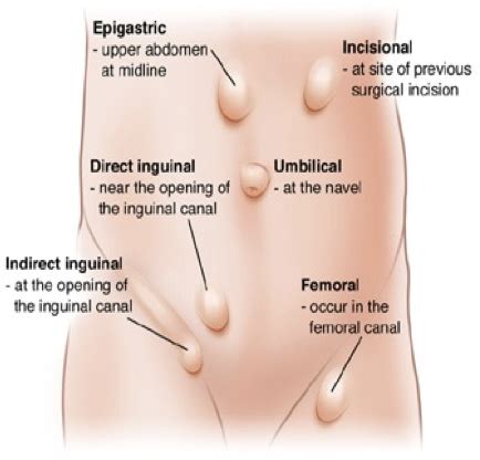 Hernias Flashcards Quizlet