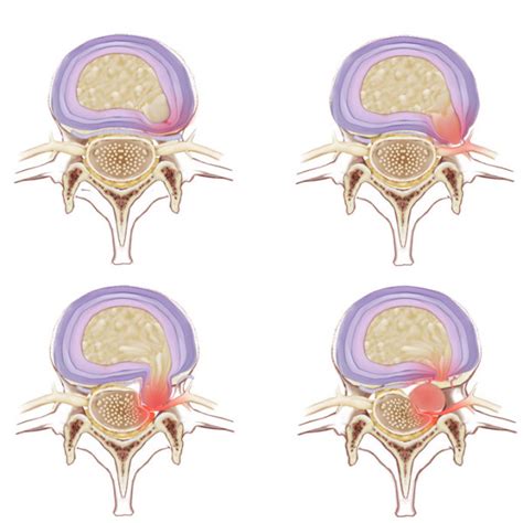 Annular Strain Annular Tear Back To Active Sports And Spinal