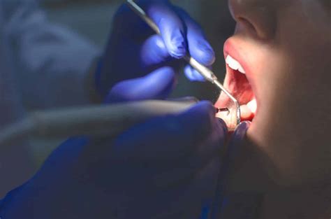 What To Expect From A Deep Teeth Cleaning | Ascent Dental Group ...