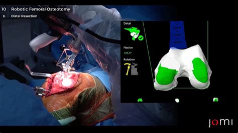 Mako Robotic Arm Assisted Total Knee Arthroplasty Youtube