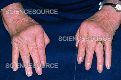 Rheumatoid Arthritis Of Hands With Uln Stock Image Science Source