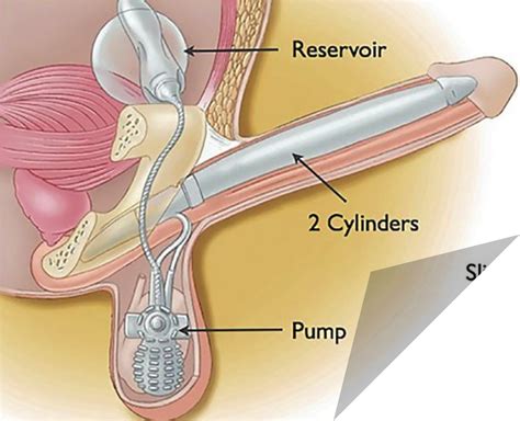 Saline Penis Telegraph