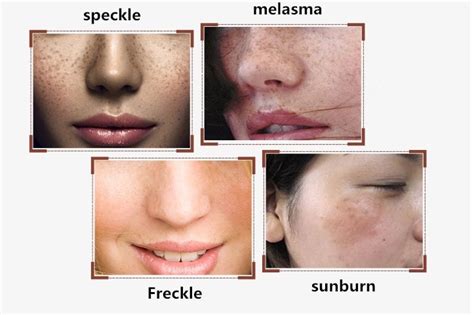 dimollaure cream