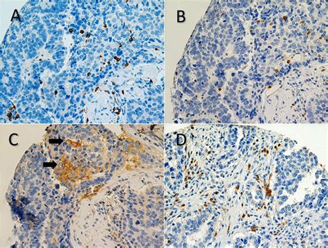 A Representative Immunohistochemistry Ihc Of Cd8 In High Grade