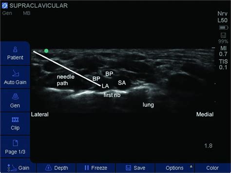 Ultrasound Guided Supraclavicular Brachial Plexus Block Anesthesia Key