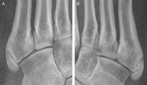 Bilateral Symptomatic Os Vesalianum Pedis: A Case Report - The Journal