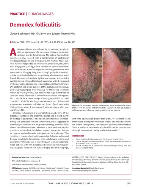 (PDF) Demodex folliculitis