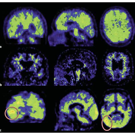 Pib Pet Scans Coronal Sagittal And Axial Views Of Pib Pet Scans