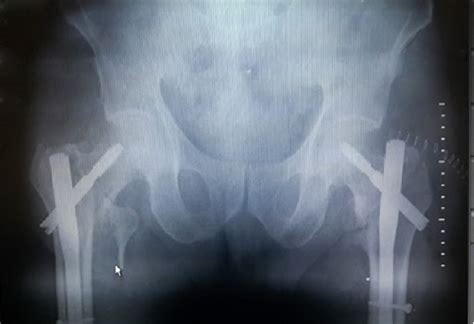 Figure 3 From Bilateral Simultaneous Intertrochanteric Fractures Of