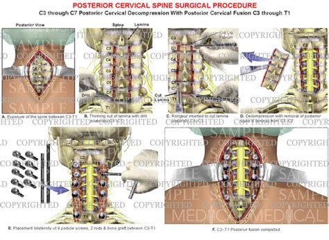 4 level - C3-C7 cervical spine decompression surgical procedure — Medical Art Works