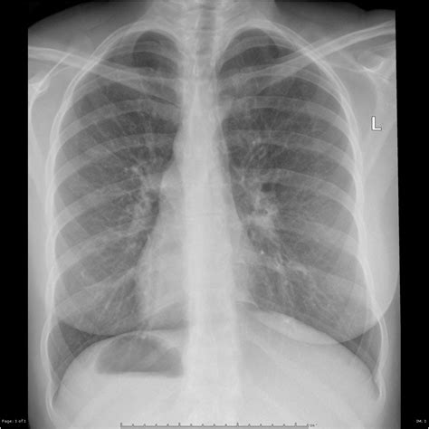 kartagener syndrome,what to know?