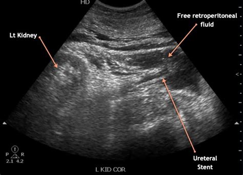 Retroperitoneal Hematoma Nephropocus