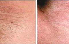 Cincinnati Laser Hair Removal - Hair Reduction Cincinnati