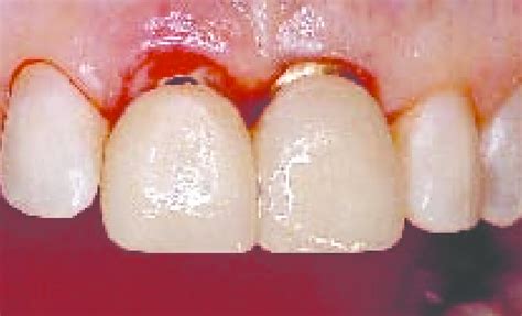 The Emergence Profile Is Restored As The Temporary Crown Of The Tooth