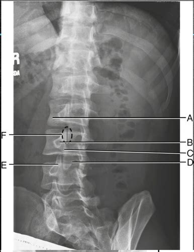 Ap Oblique Lumbar Flashcards Quizlet