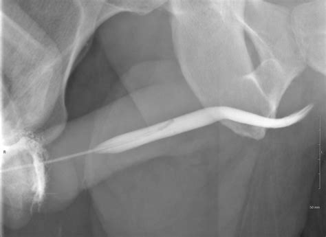 Urethral Stricture With Prior Hypospadias Repair Image