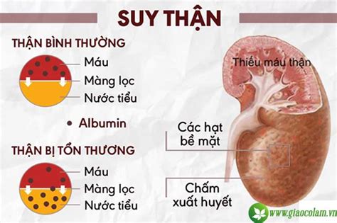 Tiểu đường Gây Suy Thận Nhận Biết Và điều Trị Thế Nào