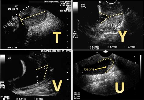 Short Cervix Full Term at Rodney Swisher blog